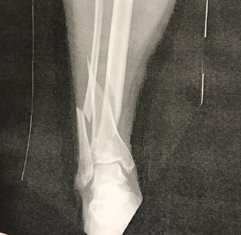 Spiral Fracture Of Tibia And Fibula Recovery Time Sekashoes