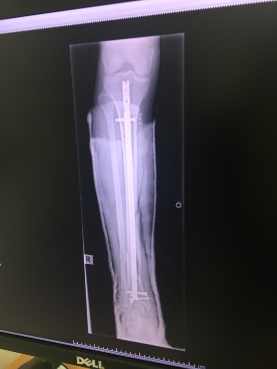 Frontiers | Simulation-based prediction of bone healing and treatment  recommendations for lower leg fractures: Effects of motion, weight-bearing  and fibular mechanics