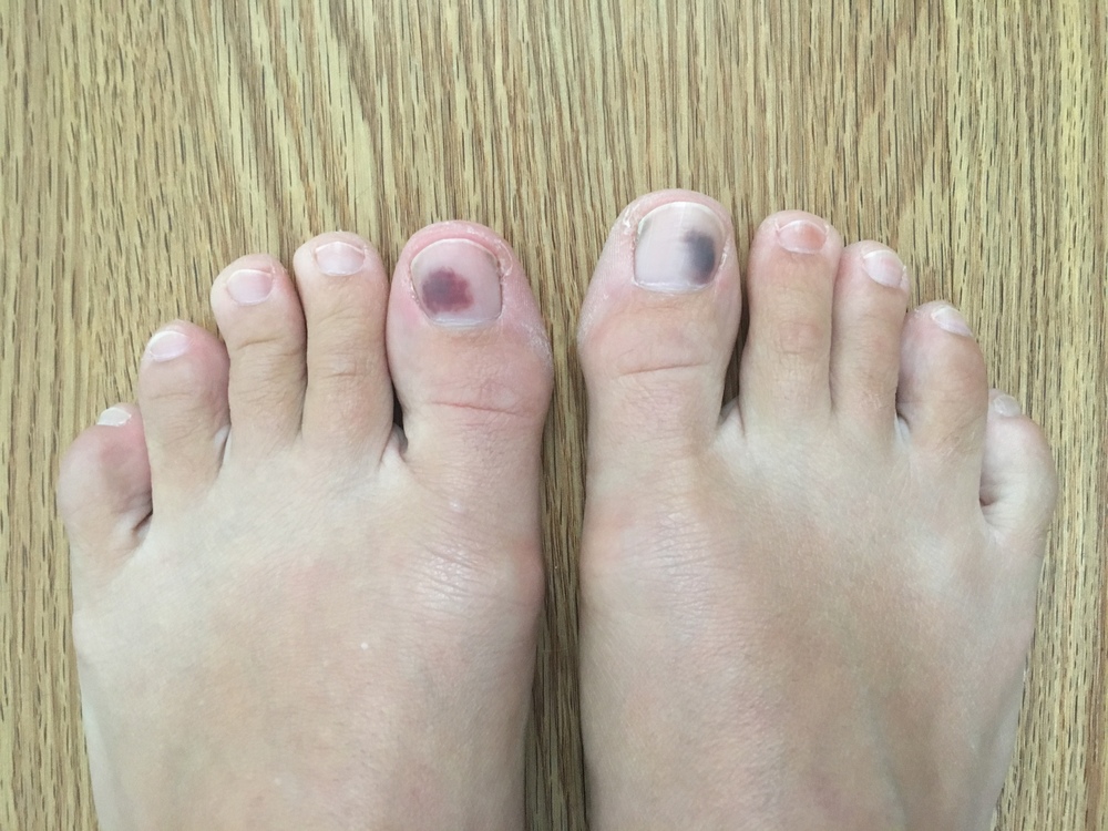 trauma-of-toenail-subungual-hematoma-bruise-stock-footage-sbv-305663855