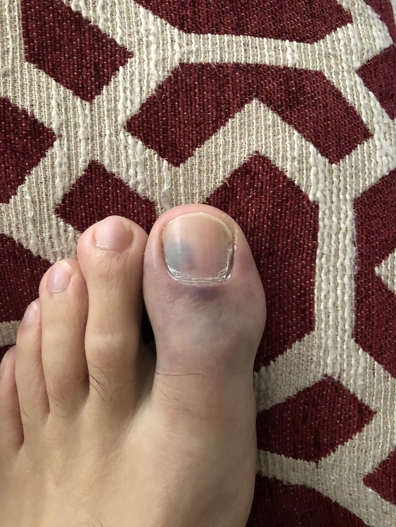 What to Do About Toenail Trauma and Injuries  Banner Health