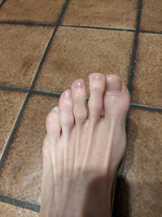 The Ugly Feet Thread. sandals that hide ugly toes. 