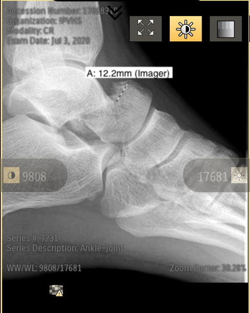 Talus fracture and partial displacement, healing advice and support