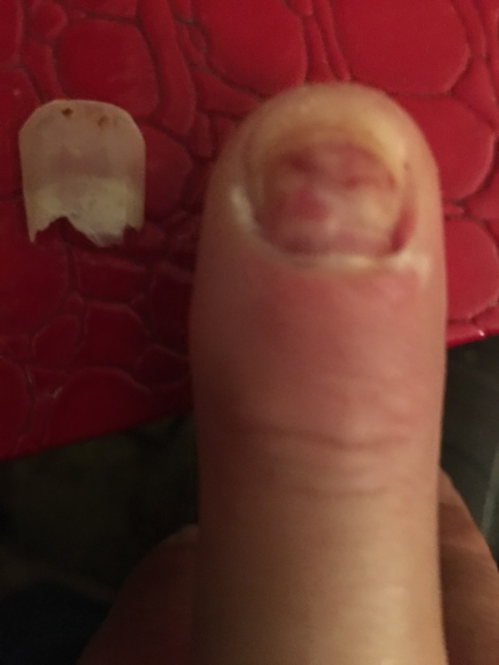 Fingernail Pain Symptoms Causes  Common Questions  Buoy