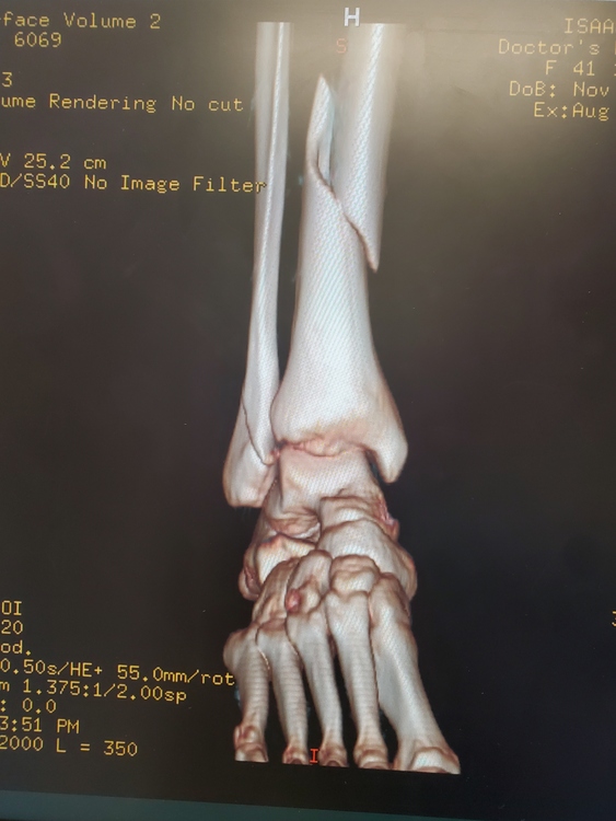 tib fib fracture physical therapy