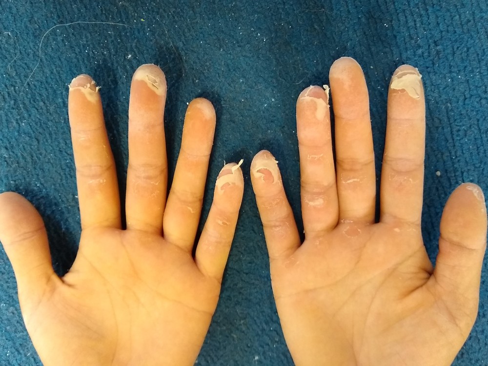 5 Ways to fix Peeling Nails, Cracked Nails and More! | LovelySkin™