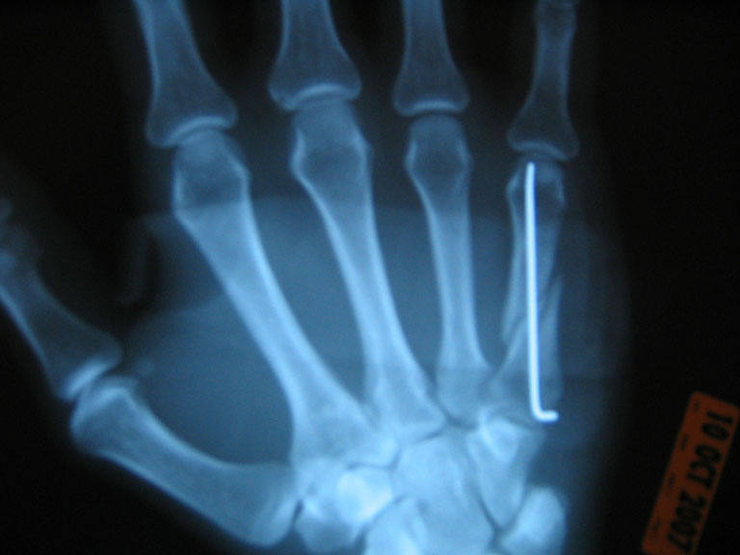 Now I'll be able to do one-finger-dynos with my bionic pinkie!