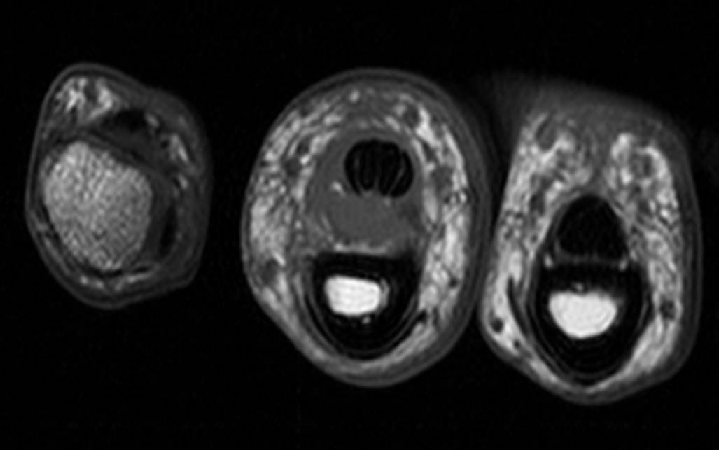 a2 pulley tear up to date