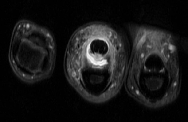Complete A2 Pulley Rupture Different view showing the abnormal fluid