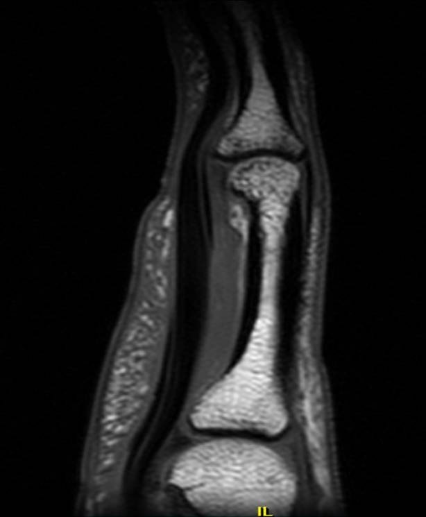 Complete A2 Pulley Rupture Long view of the finger showing that the tendon (black, on the left
