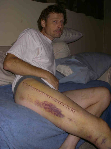 Unhappy guy with 36-stich zipper in his leg. But, he's alive and going to be okay. Hang in there Marty!
