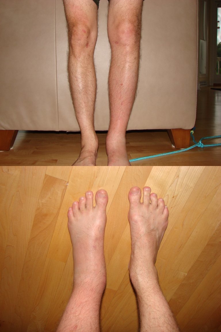 An example of untreated Lyme disease about 10 weeks after the deer tick