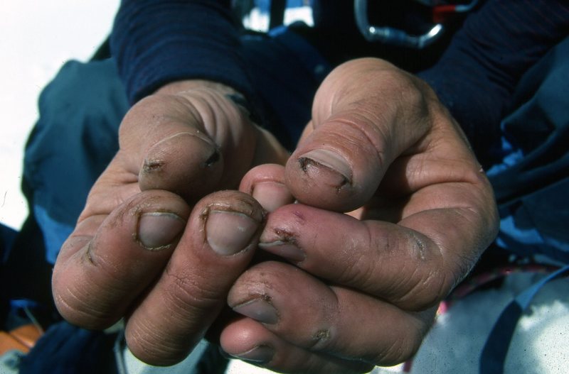 Dried, cracked, and painful fingers after a month on the glaciers.