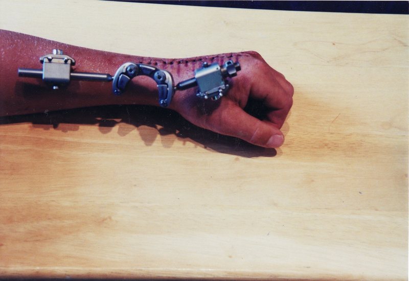 5 days after surgery. External fixator instead of cast. casts will pack out and you can move your wrist.
