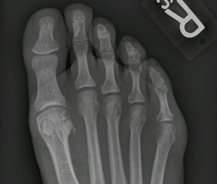 Little Mr. Chippie, on the lower right side of the big toe joint, is not a happy camper.  He must die.