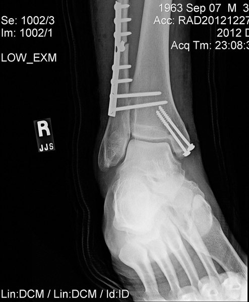 Syndesmotic Screw Removal After Broken Ankle