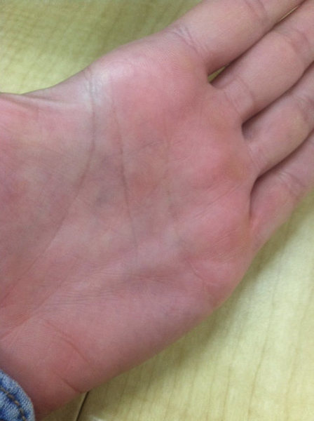 Help Lump In Palm Possible Pulley Injury Or Dupuytren s 