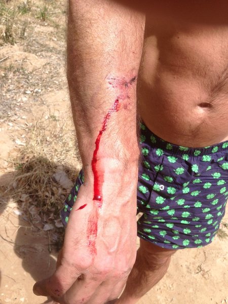  stitches after rock fall, ZION 2013