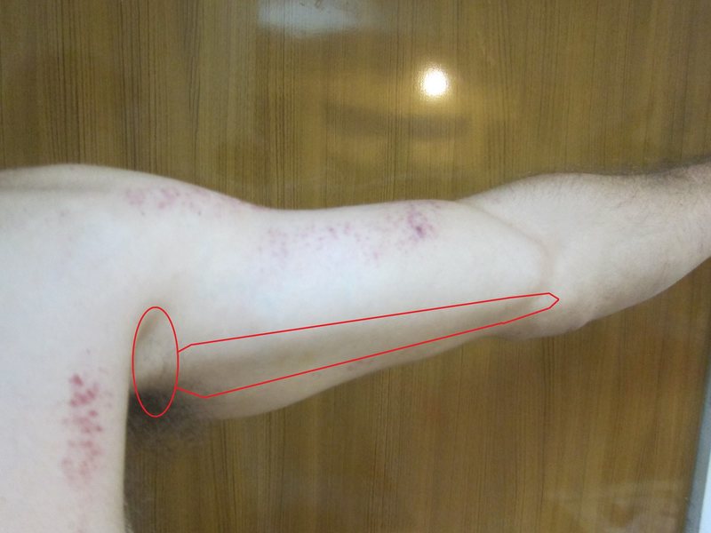 Bicep And Armpit Pain