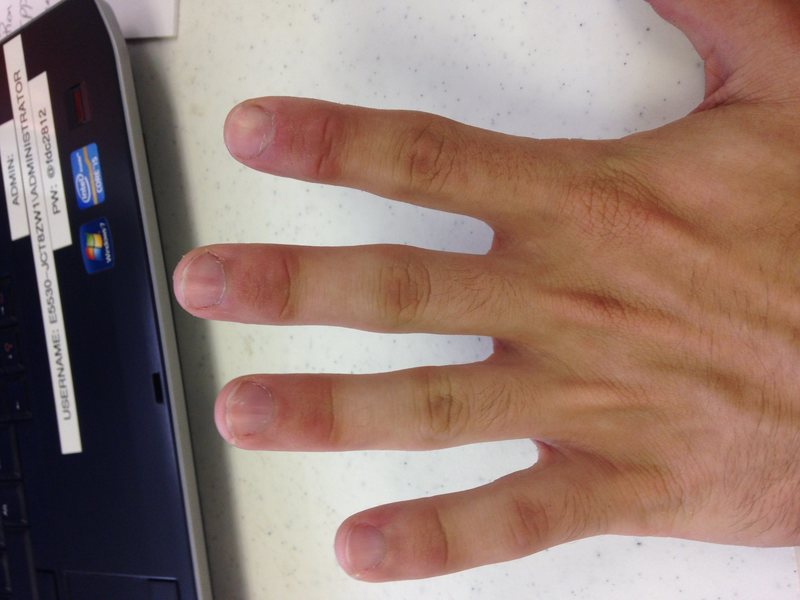 Concern with fingers. Stress Fracture?