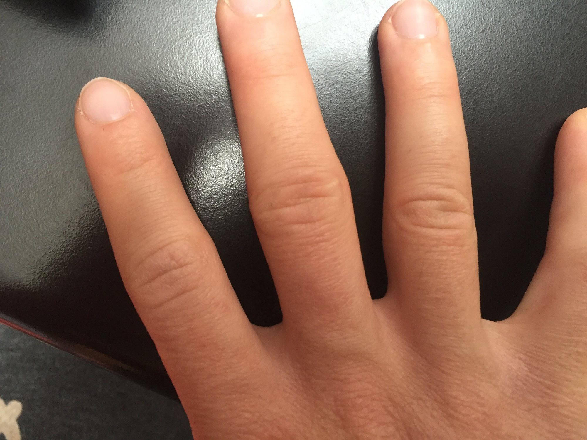 index-finger-is-quite-swollen-reduced-in-this-3-5-months-rest