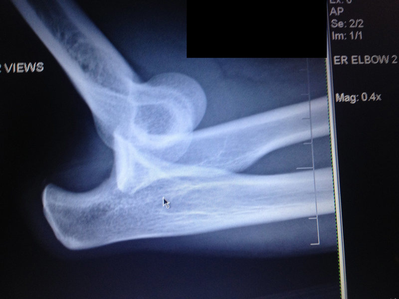 Dislocated Elbow