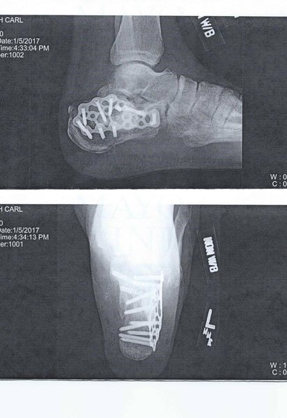 Calcaneus Surgery Orif Success Stories