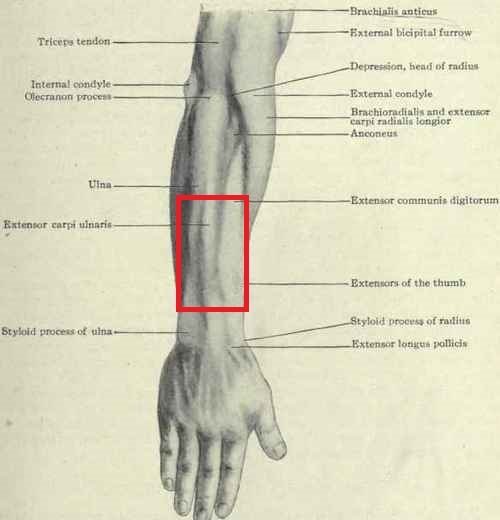Pain Tightness In Forearm Tendonitis