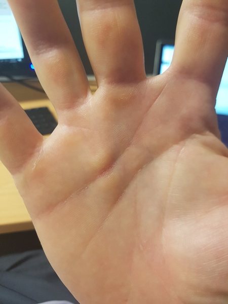 Small Painful Lump On Palm Under Skin